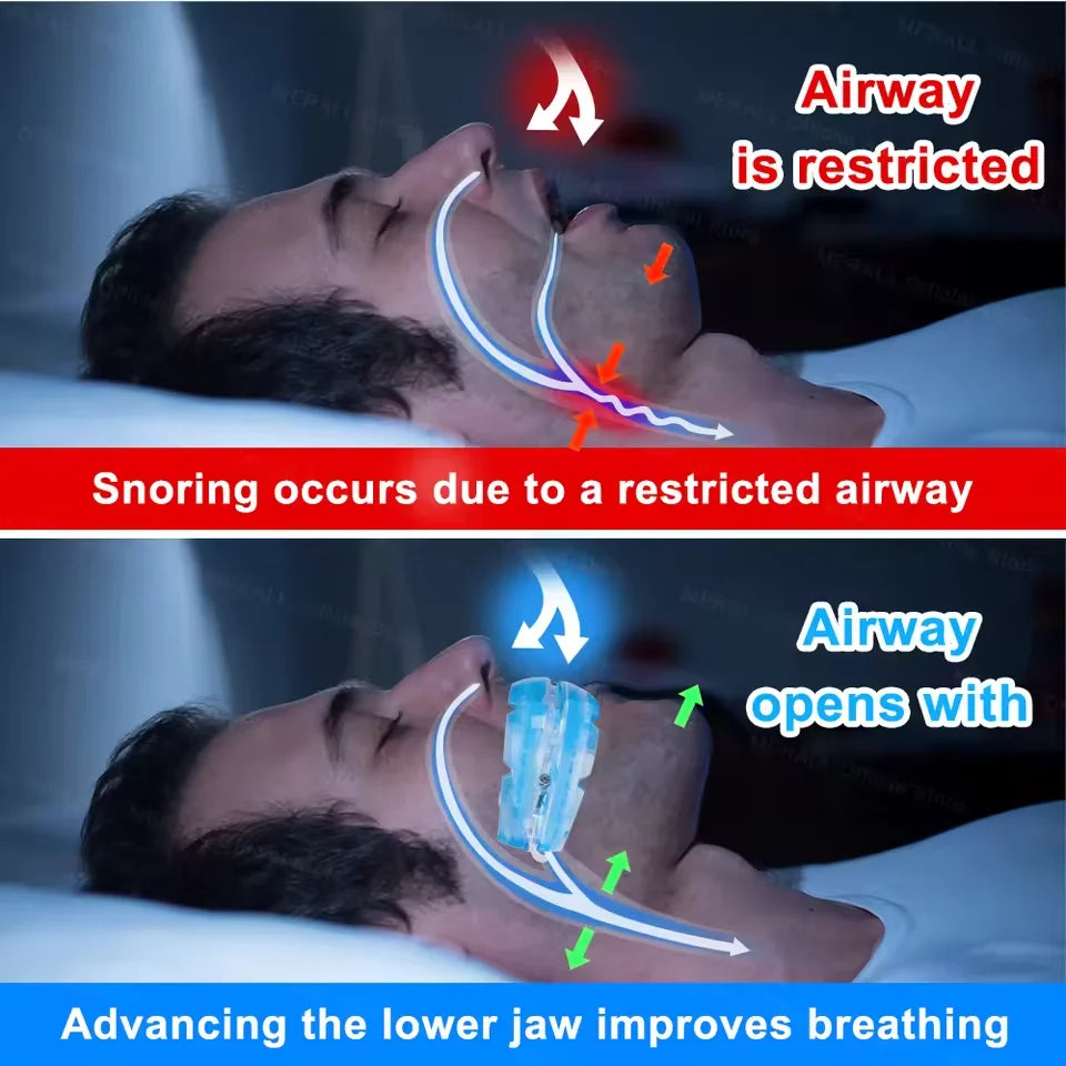 Mouth Guard Anti Snoring Soft Mouthpiece Comfortable Snoring Solution Adjustable Night Sleep Aid Bruxism Mouthpiece