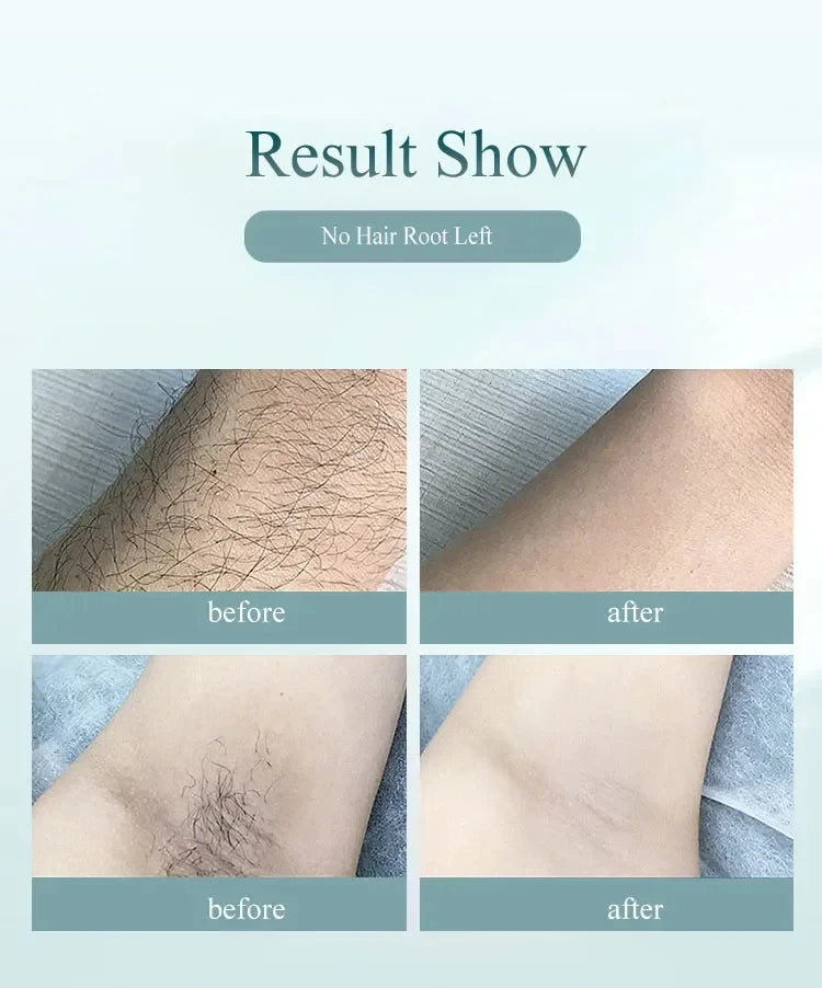 990,000 Flashes IPL Laser Hair Removal Device for Women, Painless Permanent Hair Remover for Home Use, Body, Bikini, and Face