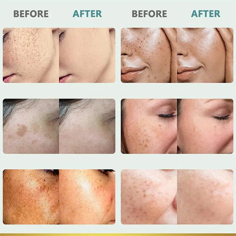 Powerful Spot-removing Whiten Cream Brighten Skin Fast Eliminates Melanin Pigmentation Melasma Dark Spots Moisturize Beauty Gel