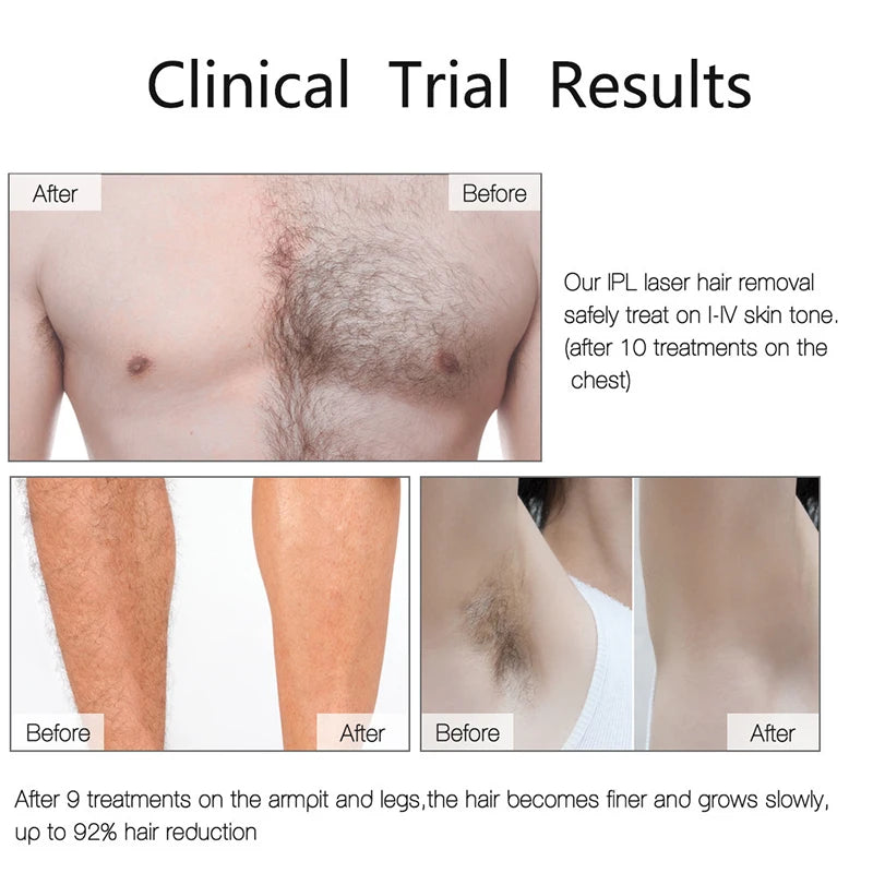 Professional IPL Laser Hair Remover 990000 Flashes for Women & Men - Painless, Permanent Hair Removal for All Body Areas